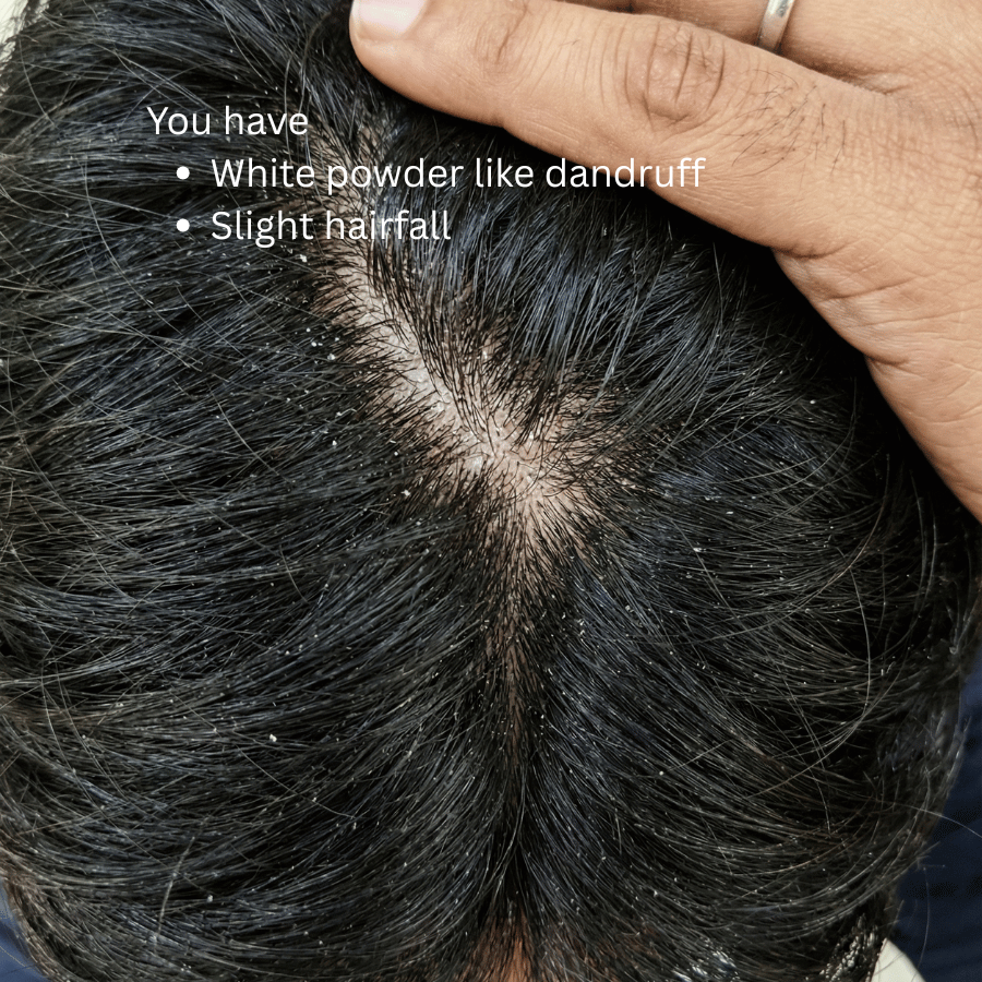 KeshaRaksha - Anti Fungal Oil