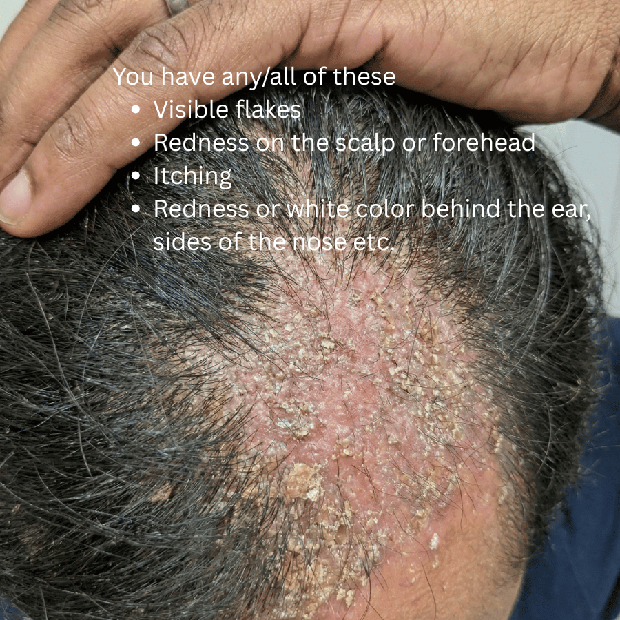 KeshaRaksha - Anti Fungal Oil